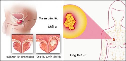 Hai loại ung thư thường găp ở nữ giới và nam giới.