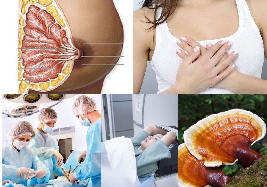 Phương pháp điều trị ung thư vú và những vấn đề liên quan