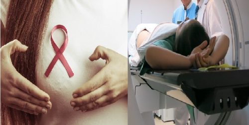 Tác dụng phụ trong cách điều trị xạ trị ung thư vú