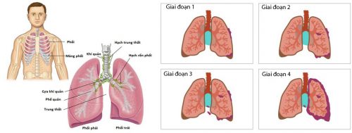 Các giai đoạn ung thư phổi 