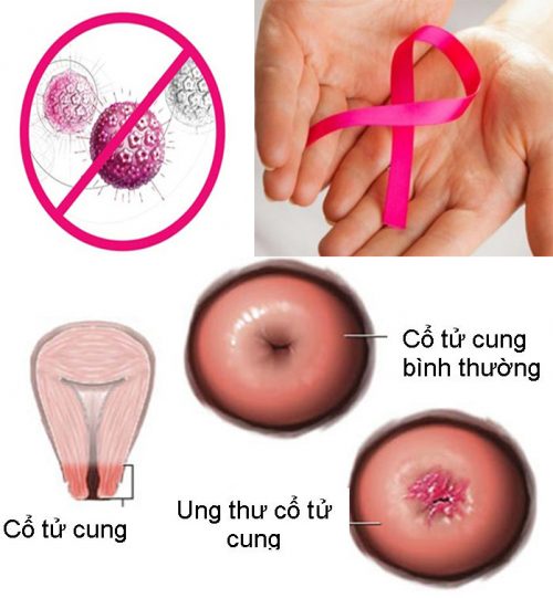 Những quan niệm sai về ung thư cổ tử cung