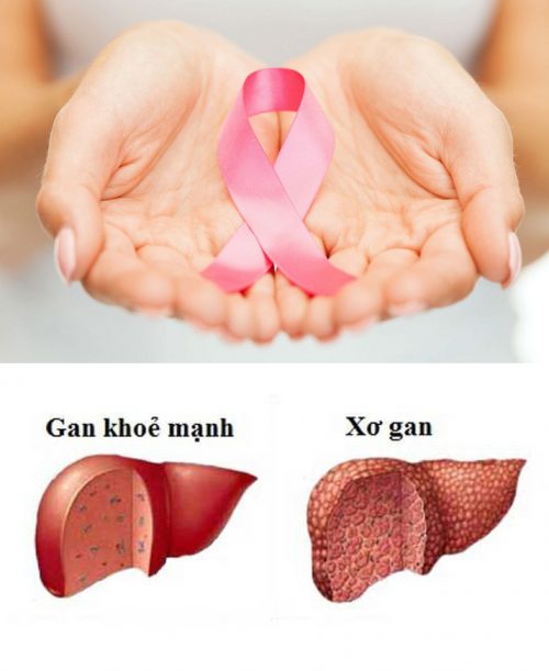 Những quan niệm sai về ung thư gan