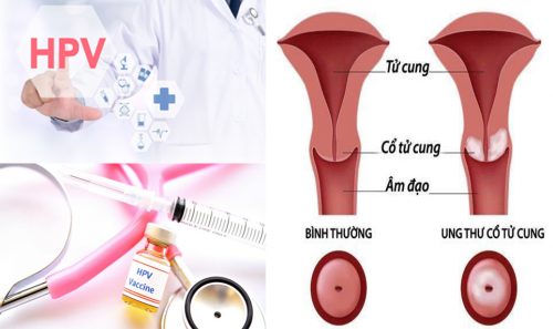 Cách phòng tránh ung thư cổ tử cung cho phụ nữ