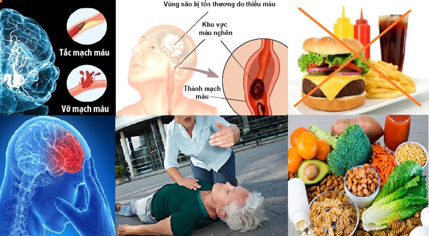 Bệnh đột quỵ não (tai biến mạch máu não)