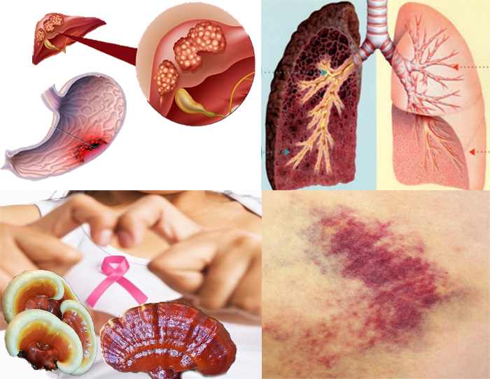 Các dấu hiệu ung thư