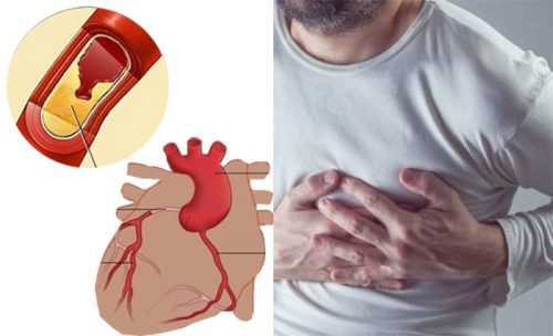 Bệnh tim mạch vành có mấy loại?