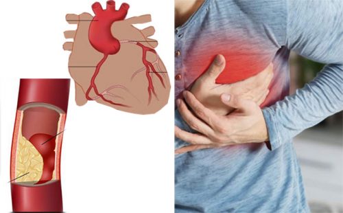 Cách chẩn đoán bệnh tim mạch vành
