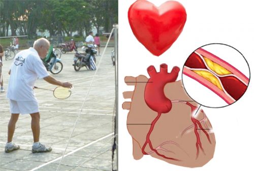  Chế độ luyện tập cho người bệnh tim mạch vành
