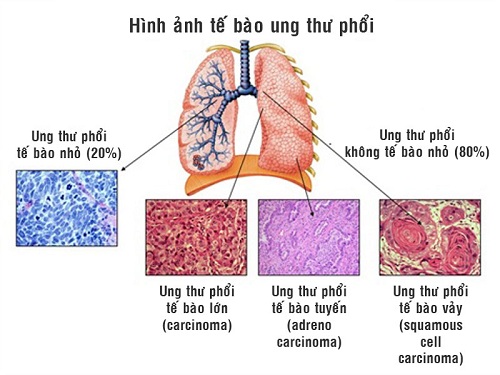 Ung thư phổi là bệnh lý thường gặp nguy hiểm đến sức khỏe
