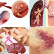 Các dấu hiệu và giai đoạn của ung thư phổi, ung thư máu, ung thư gan
