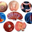 Các loại bệnh ung thư với dấu hiệu của các loại bệnh ung thư. Viện Y
