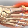 Những biến chứng nguy hại của bệnh gout
