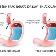 Phòng ngừa và điều trị bệnh trào ngược dạ dày thực quản