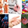 Viêm khớp với nguyên nhân triệu chứng và cách điều trị viêm khớp