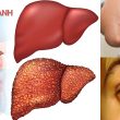 Các giai đoạn của viêm gan B và triệu chứng của từng giai đoạn