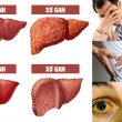 Bệnh xơ gan các giai đoạn và các biến chứng xơ gan cấp độ 1-2-3-4