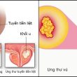 Công dụng nấm linh xanh rừng giảm nguy cơ ung thư vú, k tuyến tiền liệt