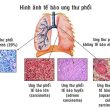Công dụng xạ đen chữa ung thư phổi thế nào? Cách dùng lá xạ đen