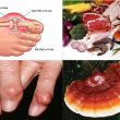 Phương pháp mới trong điều trị bệnh gout