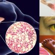 Gan nhiễm mỡ có nguy hiểm không và có chữa được gan nhiễm mỡ?