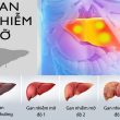Các cấp độ của gan nhiễm mỡ và diễn biến của từng cấp độ 1 2 3?