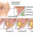 Điều trị tận gốc ung thư tiền liệt tuyến ở nam giới