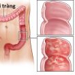 Người bị viêm đại tràng nên ăn những loại thực phẩm nào?