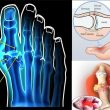 Nguyên nhân bệnh gout với dấu hiệu và cách điều trị bệnh gout hiệu quả