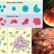 Tế bào ung thư với đặc điểm phát triển tế bào ung thư