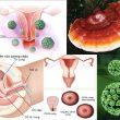 Ung thư cổ tử cung với nguyên nhân và triệu chứng ung thư cổ tử cung