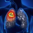 Nhận biết sớm ung thư phổi qua các dấu hiệu của bệnh