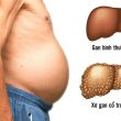 Bệnh Xơ gan cổ trướng nguy hiểm không và điều trị xơ gan cổ trướng