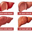 Xơ gan mất bù và còn bù là gì với triệu chứng cách điều trị hiệu quả